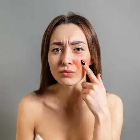 rosacea -page-cover Rosacea